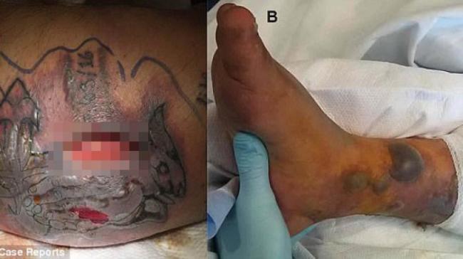 Abaikan Peringatan Usai Bikin Tato, Pria Ini Tewas Mengenaskan